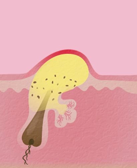 лечение угрей на спине